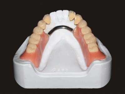 Részleges kivehető fogpótlás - Fogászat Székesfehérvár