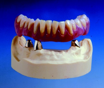 Teleszkópos fogsor - Fogászat Székesfehérvár